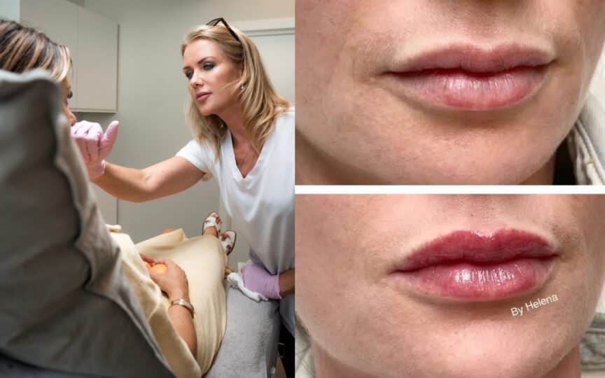 fillers i Kungsbacka - Brenke Estetik
